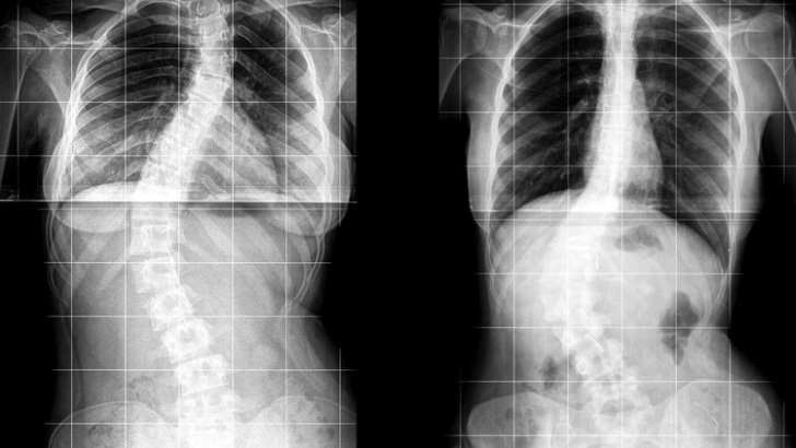 Como é feita a cirurgia de escoliose