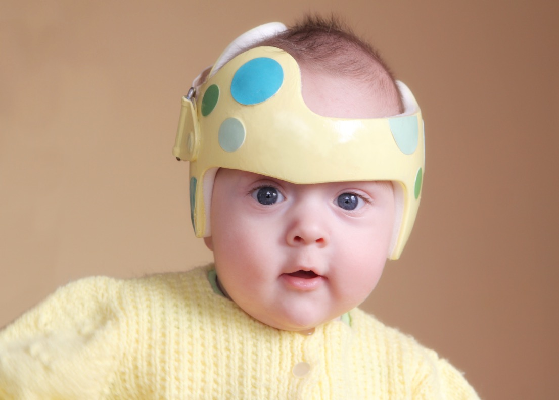 Bebê de camisa amarela com capacete para plagiocefalia
