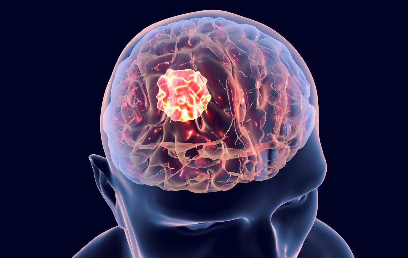 Imagem computadorizada de tumor cerebral